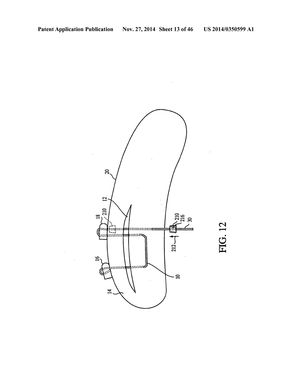 CLOSURE DEVICE AND METHOD FOR TISSUE REPAIR - diagram, schematic, and image 14