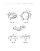 ANTERIOR CERVICAL PLATE diagram and image