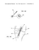 METHODS AND SYSTEMS FOR MATERIAL FIXATION diagram and image