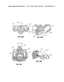 PATIENT-MATCHED APPARATUS AND METHODS FOR PERFORMING SURGICAL PROCEDURES diagram and image