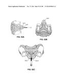 PATIENT-MATCHED APPARATUS AND METHODS FOR PERFORMING SURGICAL PROCEDURES diagram and image