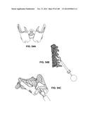 PATIENT-MATCHED APPARATUS AND METHODS FOR PERFORMING SURGICAL PROCEDURES diagram and image