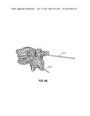 PATIENT-MATCHED APPARATUS AND METHODS FOR PERFORMING SURGICAL PROCEDURES diagram and image