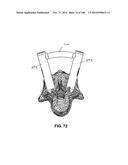 PATIENT-MATCHED APPARATUS AND METHODS FOR PERFORMING SURGICAL PROCEDURES diagram and image