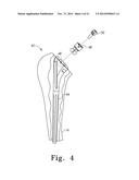 Osteotomy Protective Cover diagram and image