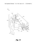 MODULAR BIOMEDICAL IMPLANTS diagram and image