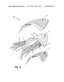 ELEMENTS FOR VERSATILITY OF A PROSTHETIC ANCHOR diagram and image