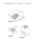 ELEMENTS FOR VERSATILITY OF A PROSTHETIC ANCHOR diagram and image