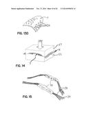 ELEMENTS FOR VERSATILITY OF A PROSTHETIC ANCHOR diagram and image