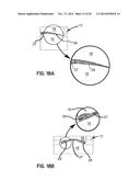 ELEMENTS FOR VERSATILITY OF A PROSTHETIC ANCHOR diagram and image