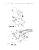 ELEMENTS FOR VERSATILITY OF A PROSTHETIC ANCHOR diagram and image