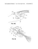 ELEMENTS FOR VERSATILITY OF A PROSTHETIC ANCHOR diagram and image