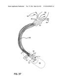 ELEMENTS FOR VERSATILITY OF A PROSTHETIC ANCHOR diagram and image