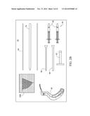 METHOD FOR TREATING JOINT PAIN AND ASSOCIATED INSTRUMENTS diagram and image