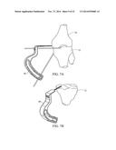 METHOD FOR TREATING JOINT PAIN AND ASSOCIATED INSTRUMENTS diagram and image