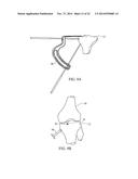 METHOD FOR TREATING JOINT PAIN AND ASSOCIATED INSTRUMENTS diagram and image