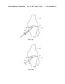 METHOD FOR TREATING JOINT PAIN AND ASSOCIATED INSTRUMENTS diagram and image