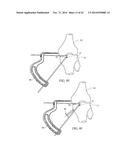 METHOD FOR TREATING JOINT PAIN AND ASSOCIATED INSTRUMENTS diagram and image