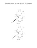 METHOD FOR TREATING JOINT PAIN AND ASSOCIATED INSTRUMENTS diagram and image