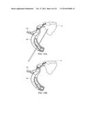 METHOD FOR TREATING JOINT PAIN AND ASSOCIATED INSTRUMENTS diagram and image