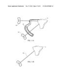 METHOD FOR TREATING JOINT PAIN AND ASSOCIATED INSTRUMENTS diagram and image