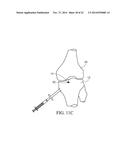 METHOD FOR TREATING JOINT PAIN AND ASSOCIATED INSTRUMENTS diagram and image