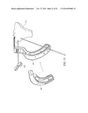 METHOD FOR TREATING JOINT PAIN AND ASSOCIATED INSTRUMENTS diagram and image