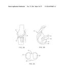 SYSTEMS AND METHODS FOR PROVIDING A FEMORAL COMPONENT diagram and image