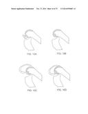 SYSTEMS AND METHODS FOR PROVIDING A FEMORAL COMPONENT diagram and image