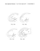 SYSTEMS AND METHODS FOR PROVIDING A FEMORAL COMPONENT diagram and image