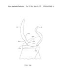 SYSTEMS AND METHODS FOR PROVIDING A FEMORAL COMPONENT diagram and image