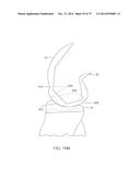 SYSTEMS AND METHODS FOR PROVIDING A FEMORAL COMPONENT diagram and image