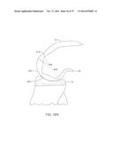 SYSTEMS AND METHODS FOR PROVIDING A FEMORAL COMPONENT diagram and image