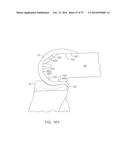 SYSTEMS AND METHODS FOR PROVIDING A FEMORAL COMPONENT diagram and image