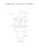 SYSTEMS AND METHODS FOR PROVIDING A FEMORAL COMPONENT diagram and image