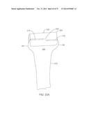 SYSTEMS AND METHODS FOR PROVIDING A FEMORAL COMPONENT diagram and image