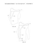 SYSTEMS AND METHODS FOR PROVIDING A FEMORAL COMPONENT diagram and image