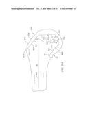 SYSTEMS AND METHODS FOR PROVIDING A FEMORAL COMPONENT diagram and image