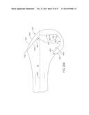 SYSTEMS AND METHODS FOR PROVIDING A FEMORAL COMPONENT diagram and image