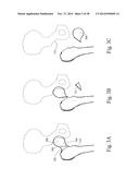 METHODS AND SYSTEMS FOR HIP REPLACEMENT diagram and image