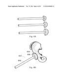 METHODS AND SYSTEMS FOR HIP REPLACEMENT diagram and image