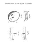 METHODS AND SYSTEMS FOR HIP REPLACEMENT diagram and image