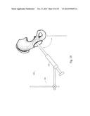 METHODS AND SYSTEMS FOR HIP REPLACEMENT diagram and image