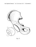 METHODS AND SYSTEMS FOR HIP REPLACEMENT diagram and image