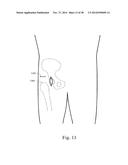 METHODS AND SYSTEMS FOR HIP REPLACEMENT diagram and image