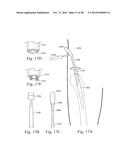 METHODS AND SYSTEMS FOR HIP REPLACEMENT diagram and image