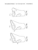 METHODS AND SYSTEMS FOR HIP REPLACEMENT diagram and image