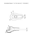 METHODS AND SYSTEMS FOR HIP REPLACEMENT diagram and image