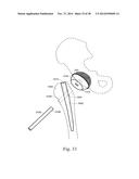 METHODS AND SYSTEMS FOR HIP REPLACEMENT diagram and image