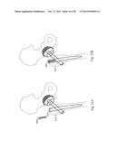 METHODS AND SYSTEMS FOR HIP REPLACEMENT diagram and image